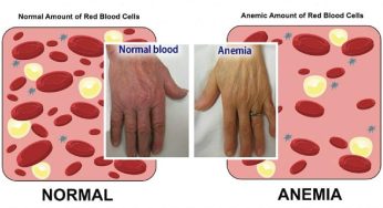 Ferro basso: otto super alimenti utili contro l’anemia