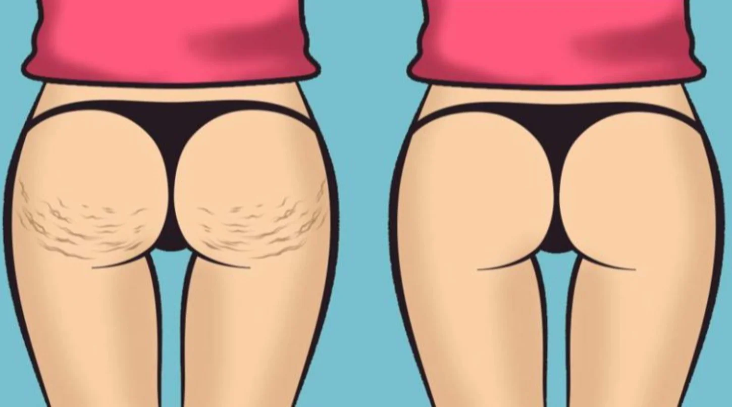 La dieta anti cellulite che brucia il grasso in una sola settimana! Con menù