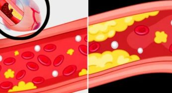 Colesterolo alto: la dieta che può aiutarti ad abbassarlo