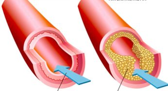 L’ ottimo rimedio che sblocca le arterie ed elimina grasso e colesterolo