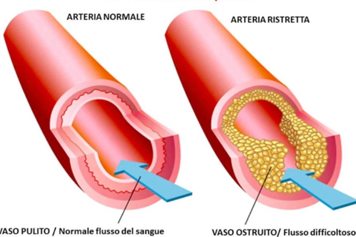 L’ ottimo rimedio che sblocca le arterie ed elimina grasso e colesterolo